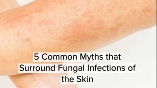 5 Common Myths that Surround Fungal Infection of Skin