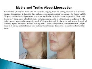 Myths and Truths About Liposuction
Beverly Hills, being the prime spot for cosmetic surgery, has been seeing an increase of patients
seeking liposuction. In fact, it’s the number one requested surgical procedure. Dr. Ordon and Dr.
Chopra explain that the liposuction procedure used to be exclusive for the super rich. Now, with
the surgery being more affordable and available, many people of all kinds are considering it. But
before you or anyone else moves forward, it’s best to know all the facts...as well as weed out all of
the false myths. Thanks to detailed training and 35 years of experience, Doctors Ordon& Chopra
have built an unparalleled reputation, making them the right doctors to contact to find out all the
facts.

 