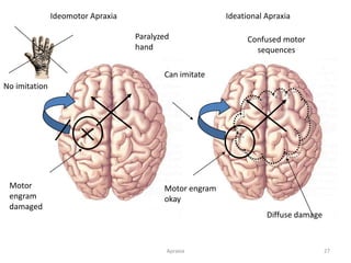 Apraxia 27
Motor
engram
damaged
Paralyzed
hand
Ideational ApraxiaIdeomotor Apraxia
No imitation
Motor engram
okay
Diffuse damage
Can imitate
Confused motor
sequences
 