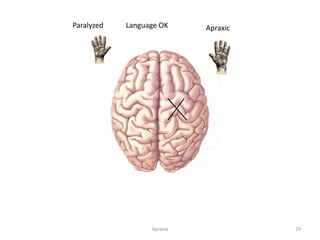 Apraxia 29
Paralyzed ApraxicLanguage OK
 