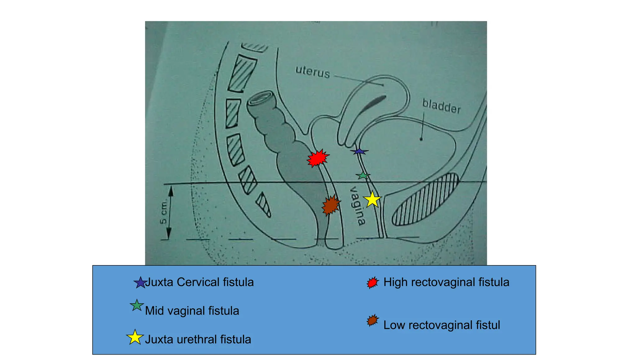 Classification Of Vesicovaginal Fistulas PPT classification-of-vesicovaginal-fistulas-ppt
