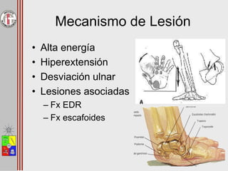 Mecanismo de Lesión
• Alta energía
• Hiperextensión
• Desviación ulnar
• Lesiones asociadas
– Fx EDR
– Fx escafoides
 