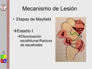 Mecanismo de Lesión
• Etapas de Mayfield
Estadío I
Disocioación
escafolunar/fractura
de escafoides
 