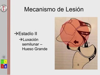 Mecanismo de Lesión
Estadío II
Luxación
semilunar –
Hueso Grande
 
