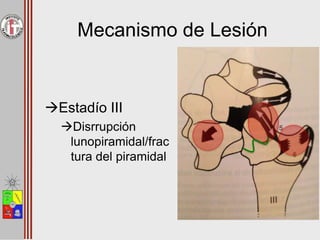 Mecanismo de Lesión
Estadío III
Disrrupción
lunopiramidal/frac
tura del piramidal
 