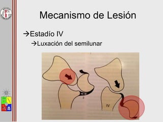 Mecanismo de Lesión
Estadío IV
Luxación del semilunar
 
