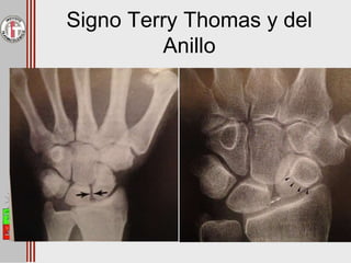 Signo Terry Thomas y del
Anillo
 