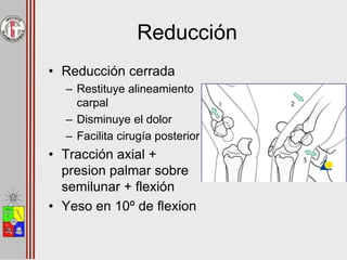 Reducción
• Reducción cerrada
– Restituye alineamiento
carpal
– Disminuye el dolor
– Facilita cirugía posterior
• Tracción axial +
presion palmar sobre
semilunar + flexión
• Yeso en 10º de flexion
 