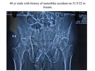 48 yr male with history of motorbike accident on 31/3/22 in
Assam.
 
