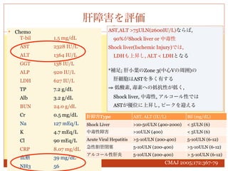 肝障害を評価
   Chemo                            AST,ALT >75ULN(2600IU/L)ならば,
     T-bil   1.5 mg/dL                90%がShock liver or 中毒性
     AST     2328 IU/L               Shock liver(Ischemic Injury)では,
     ALT     1364 IU/L                LDHも上昇し, ALT < LDHとなる
     GGT     138 IU/L
     ALP     920 IU/L                *補足; 肝小葉のZone 3(中心Vの周囲)の

     LDH     627 IU/L                 肝細胞はASTを多く有する

     TP      7.2 g/dL                ⇒ 低酸素, 毒素への抵抗性が低く,

     Alb     3.2 g/dL                 Shock liver, 中毒性, アルコール性では
     BUN     24.0 g/dL                ASTが優位に上昇し, ピークを迎える
     Cr      0.5 mg/dL    肝障害Type                 AST, ALT (IU/L)        Bil (mg/dL)
     Na      127 mEq/L    Shock Liver             >10-50ULN (400-2000)   < 5ULN (6)
     K       4.7 mEq/L    中毒性障害                   >10ULN (400)           < 5ULN (6)

     Cl      90 mEq/L     Acute Viral Hepatitis   >5-10ULN (200-400)     5-10ULN (6-12)
                          急性胆管閉塞                  5-10ULN (200-400)      >5-10ULN (6-12)
     CRP     8.07 mg/dL
                          アルコール性肝炎                5-10ULN (200-400)      > 5-10ULN (6-12)
     血糖      39 mg/dL
                                                                 CMAJ 2005;172:367-79
     NH3     56
 