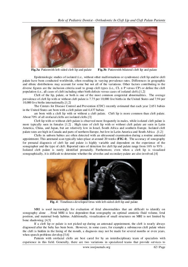 Role of Pediatric Dentist Orthodontic In Cleft Lip and Cleft Palate…