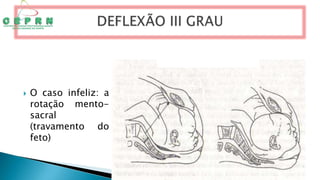  O caso infeliz: a
rotação mento-
sacral
(travamento do
feto)
 