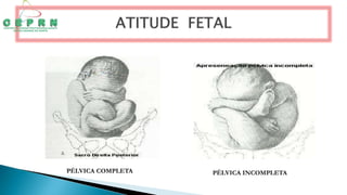 PÉLVICA COMPLETA PÉLVICA INCOMPLETA
 