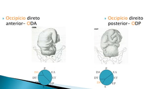  Occipício direito
posterior- ODP
 Occipício direto
anterior- ODA
P
S
EA
EP
DA
DP
DT ET
P
S
EA
EP
DA
DP
DT ET
 