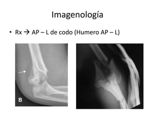 Imagenología
• Rx  AP – L de codo (Humero AP – L)
 