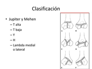 Clasificación
• Jupiter y Mehen
– T alta
– T baja
– Y
– H
– Lambda medial
o lateral
 