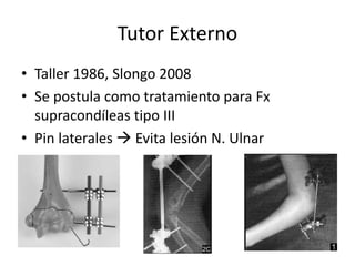 Tutor Externo
• Taller 1986, Slongo 2008
• Se postula como tratamiento para Fx
supracondíleas tipo III
• Pin laterales  Evita lesión N. Ulnar
 