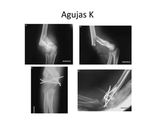 Agujas K
 