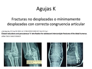 Agujas K
Fracturas no desplazadas o mínimamente
desplazadas con correcta congruencia articular
 