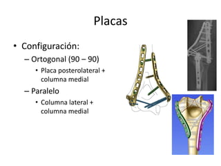 Placas
• Configuración:
– Ortogonal (90 – 90)
• Placa posterolateral +
columna medial
– Paralelo
• Columna lateral +
columna medial
 