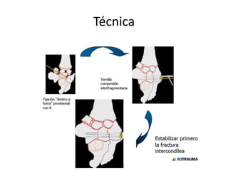 Técnica
 