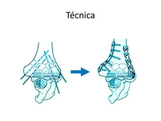 Técnica
 
