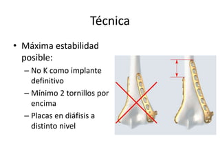 Técnica
• Máxima estabilidad
posible:
– No K como implante
definitivo
– Mínimo 2 tornillos por
encima
– Placas en diáfisis a
distinto nivel
 