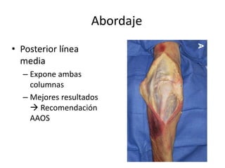 Abordaje
• Posterior línea
media
– Expone ambas
columnas
– Mejores resultados
 Recomendación
AAOS
 