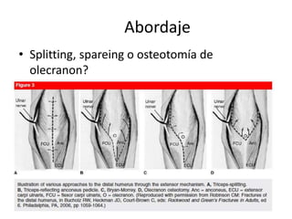 Abordaje
• Splitting, spareing o osteotomía de
olecranon?
 