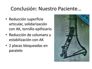 Conclusión: Nuestro Paciente…
• Reducción superficie
articular, solidarización
con AK, tornillo epifisiario
• Reducción de columans y
estabilización con AK
• 2 placas bloqueadas en
paralelo
 