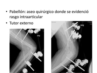 • Pabellón: aseo quirúrgico donde se evidenció
rasgo intraarticular
• Tutor externo
 