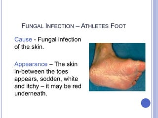 FUNGAL INFECTION – ATHLETES FOOT
Cause - Fungal infection
of the skin.
Appearance – The skin
in-between the toes
appears, sodden, white
and itchy – it may be red
underneath.
 