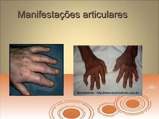 Manifestações articularesManifestações articulares
 