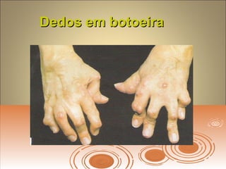 Dedos em botoeiraDedos em botoeira
 