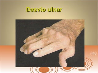 Desvio ulnarDesvio ulnar
 