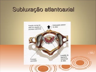 Subluxação atlantoaxialSubluxação atlantoaxial
 