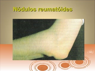 Nódulos reumatóidesNódulos reumatóides
 