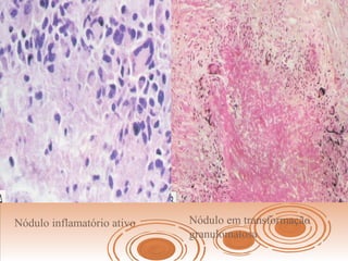 Nódulo inflamatório ativo Nódulo em transformação
granulomatosa
 