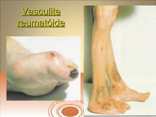 VasculiteVasculite
reumatóidereumatóide
 