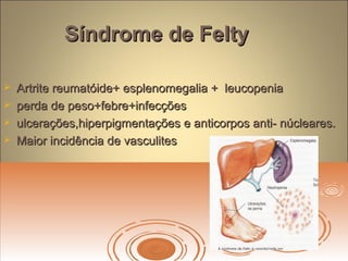 Síndrome de FeltySíndrome de Felty
 Artrite reumatóide+ esplenomegalia + leucopeniaArtrite reumatóide+ esplenomegalia + leucopenia
 perda de peso+febre+infecçõesperda de peso+febre+infecções
 ulcerações,hiperpigmentações e anticorpos anti- núcleares.ulcerações,hiperpigmentações e anticorpos anti- núcleares.
 Maior incidência de vasculitesMaior incidência de vasculites
 