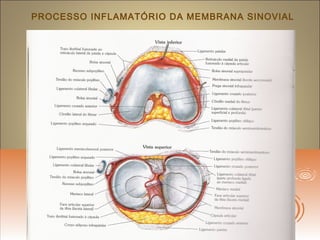 PROCESSO INFLAMATÓRIO DA MEMBRANA SINOVIAL
 