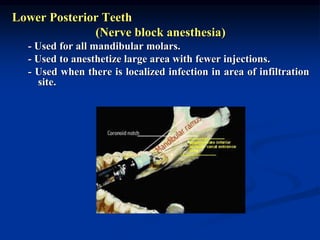 Lower Posterior Teeth
(Nerve block anesthesia)
- Used for all mandibular molars.
- Used to anesthetize large area with fewer injections.
- Used when there is localized infection in area of infiltration
site.
 