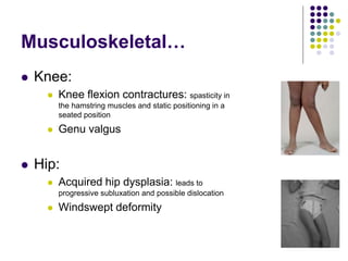 Musculoskeletal…
 Knee:
 Knee flexion contractures: spasticity in
the hamstring muscles and static positioning in a
seated position
 Genu valgus
 Hip:
 Acquired hip dysplasia: leads to
progressive subluxation and possible dislocation
 Windswept deformity
 