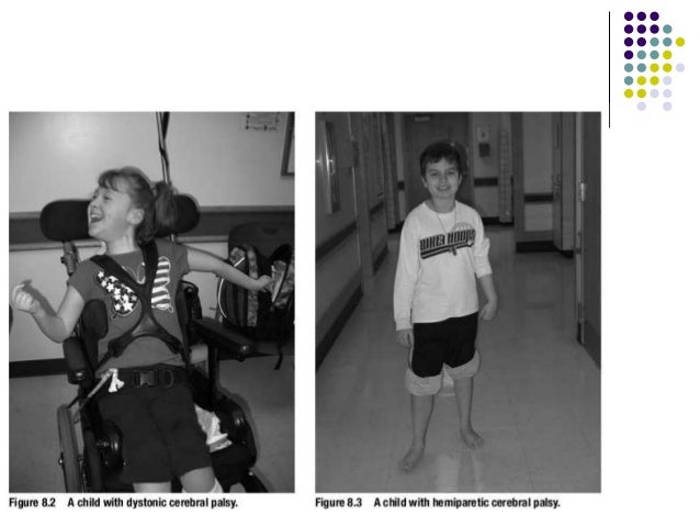 Cerebral palsy