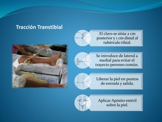 Tibia Salida N7. Materiales de Enyesado | PPTX