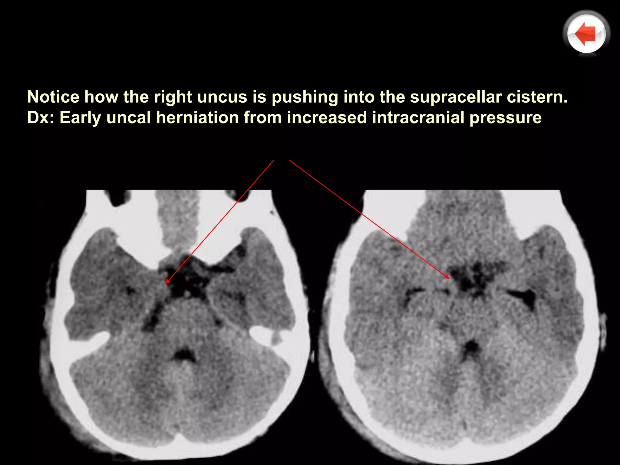 Notice how the right uncus is pushing into the supracellar cistern.
Dx: Early uncal herniation from increased intracranial pressure
 