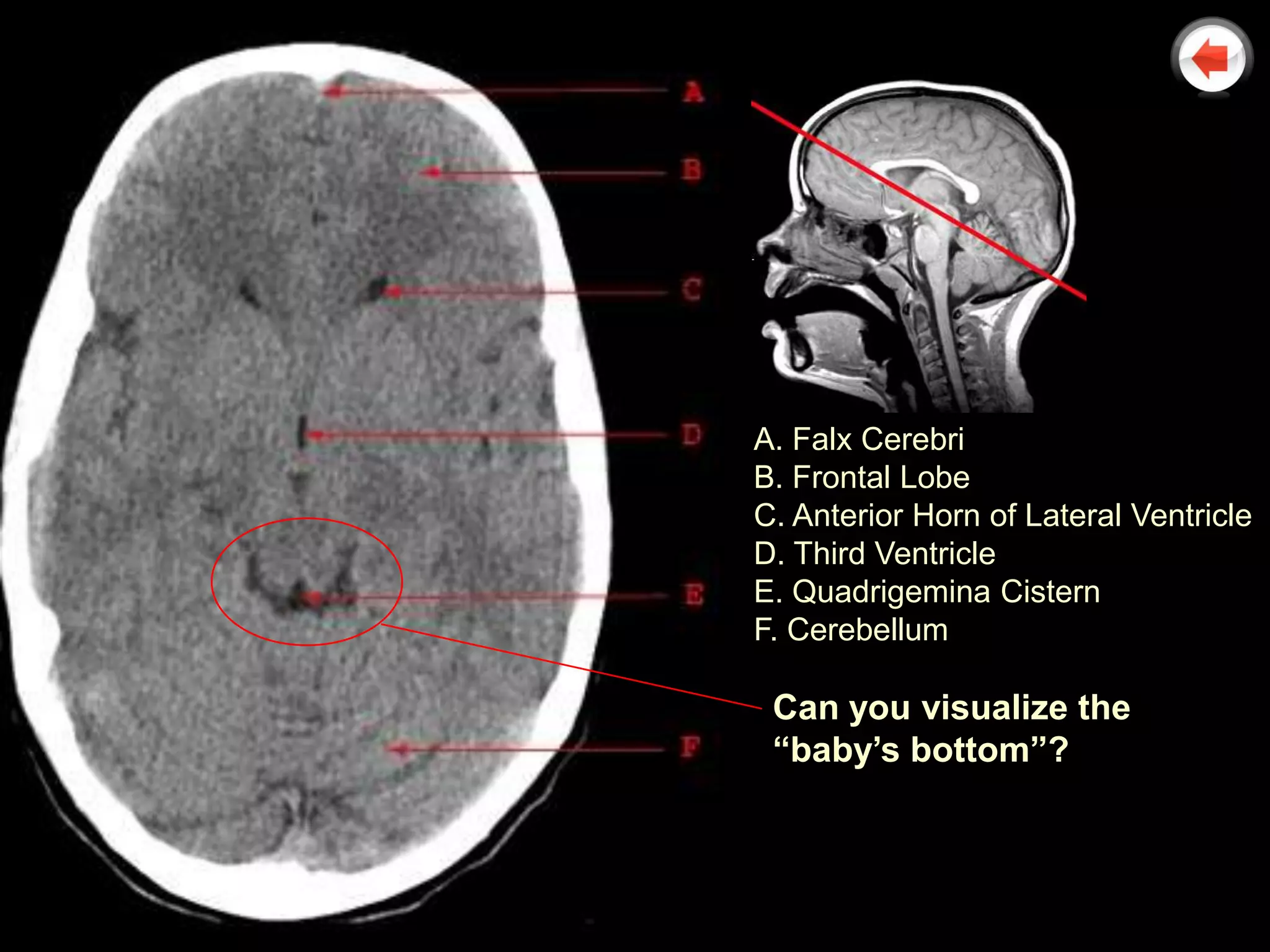 A. Falx Cerebri
B. Frontal Lobe
C. Anterior Horn of Lateral Ventricle
D. Third Ventricle
E. Quadrigemina Cistern
F. Cerebellum

 Can you visualize the
 “baby’s bottom”?
 