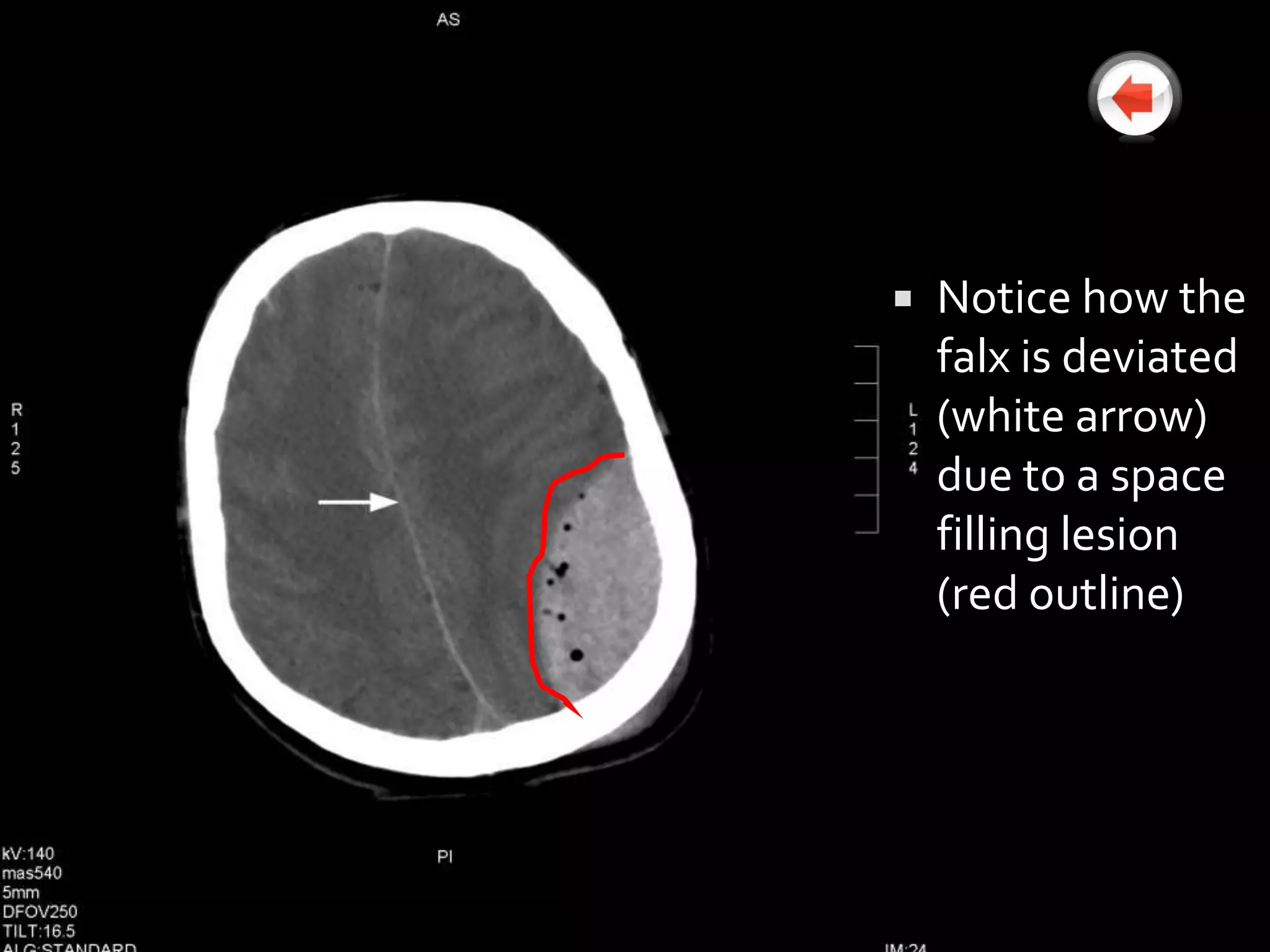    Notice how the
    falx is deviated
    (white arrow)
    due to a space
    filling lesion
    (red outline)
 
