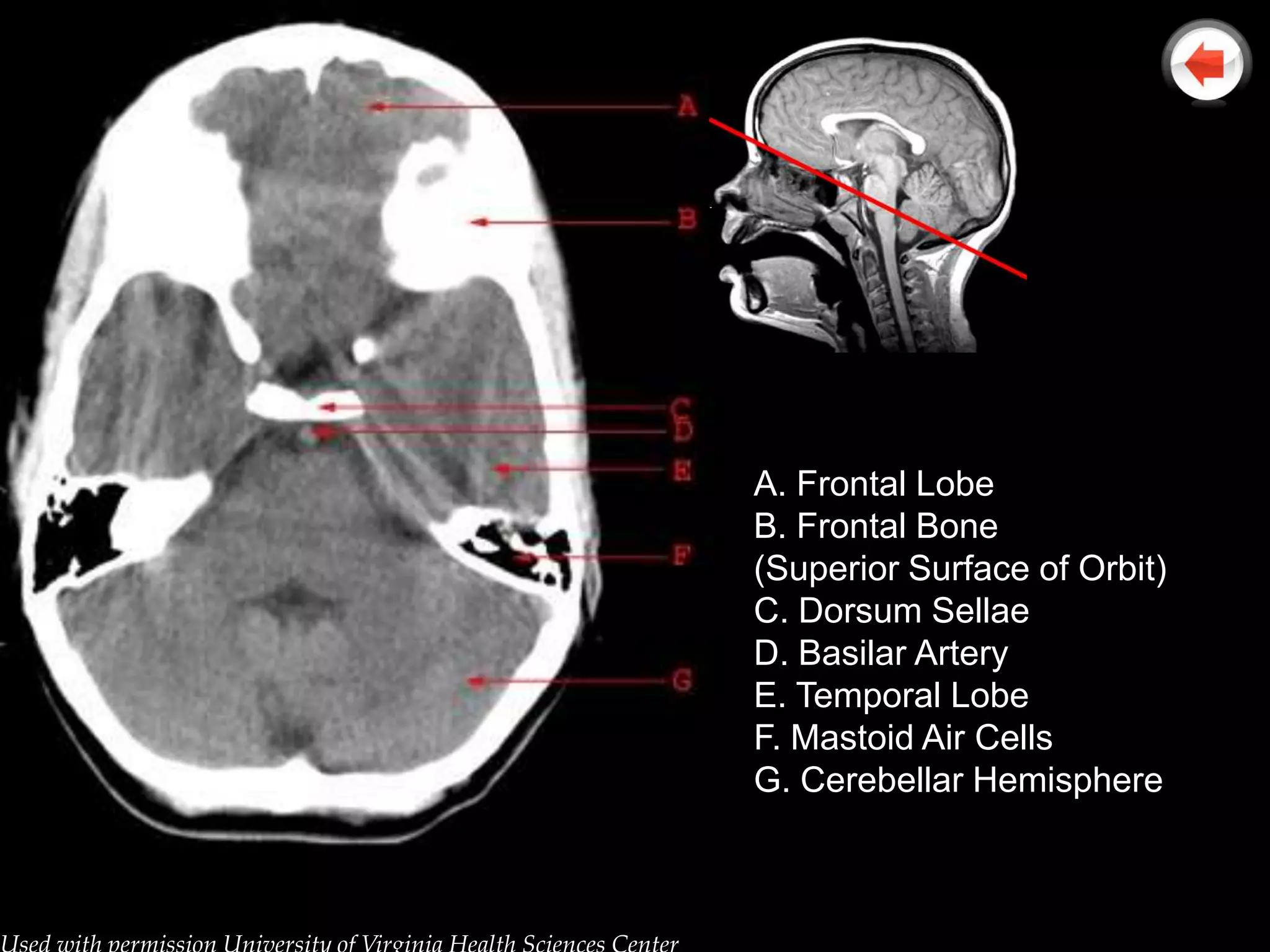 A. Frontal Lobe
B. Frontal Bone
(Superior Surface of Orbit)
C. Dorsum Sellae
D. Basilar Artery
E. Temporal Lobe
F. Mastoid Air Cells
G. Cerebellar Hemisphere
 