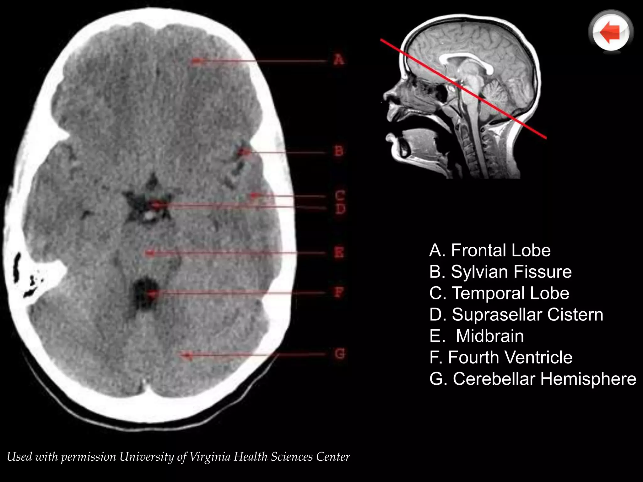 A. Frontal Lobe
                                                                     B. Sylvian Fissure
                                                                     C. Temporal Lobe
                                                                     D. Suprasellar Cistern
                                                                     E. Midbrain
                                                                     F. Fourth Ventricle
                                                                     G. Cerebellar Hemisphere



Used with permission University of Virginia Health Sciences Center
 